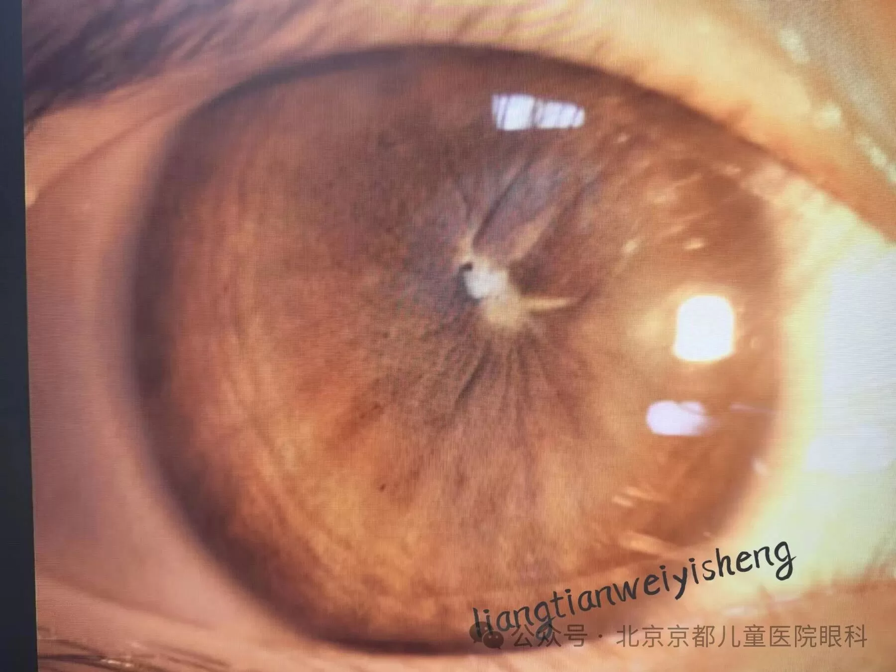 Unlock the pupil with One-stop Surgery!