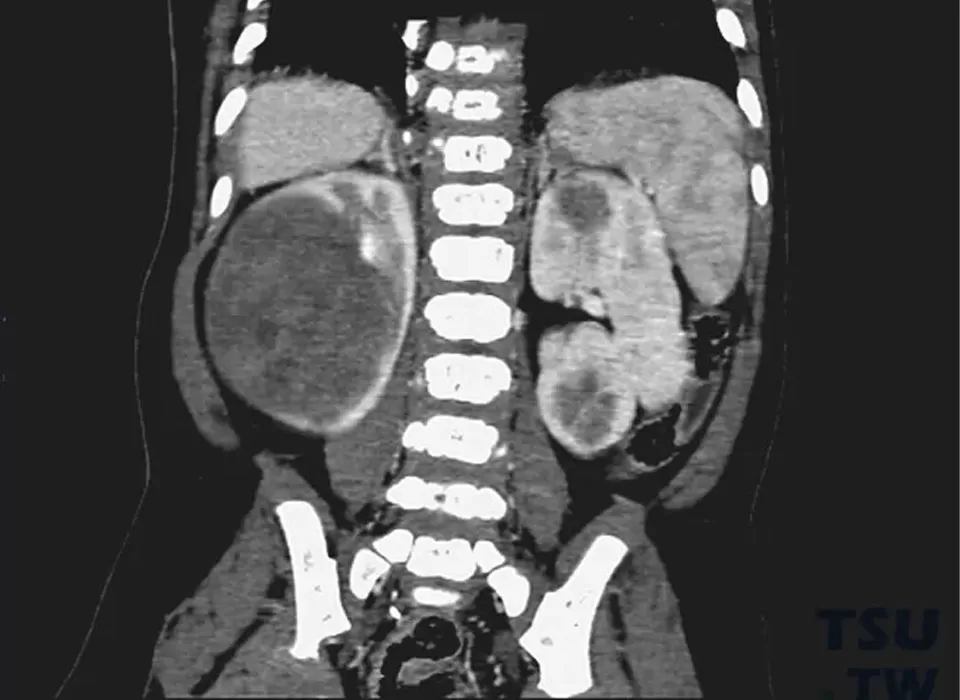 Guarding the Young Buds: A Century-long Battle to Conquer Childhood Nephroblastoma