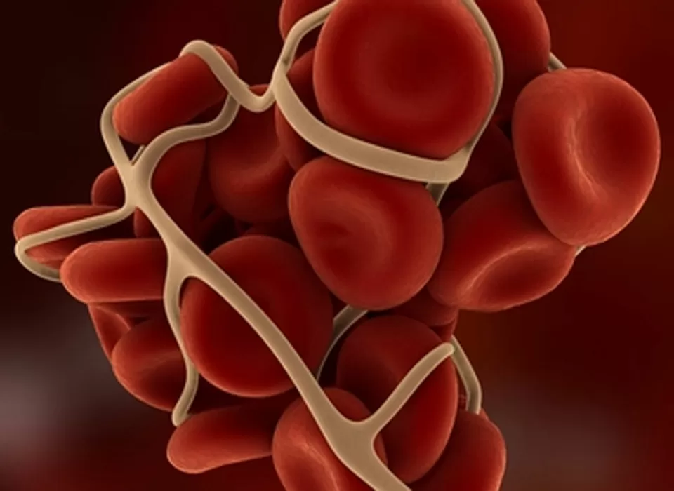 WAS Syndrome: A Global Battle Against Platelet and Immune Deficiency